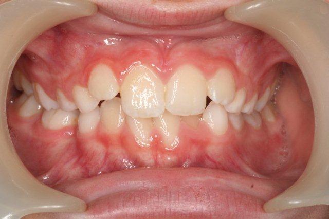 Anterior crossbite after treatment