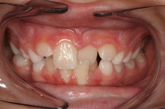 Anterior crossbite before treatment