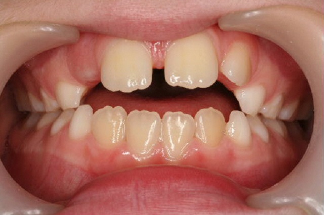 Anterior openbite