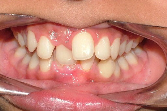 Crowded teeth