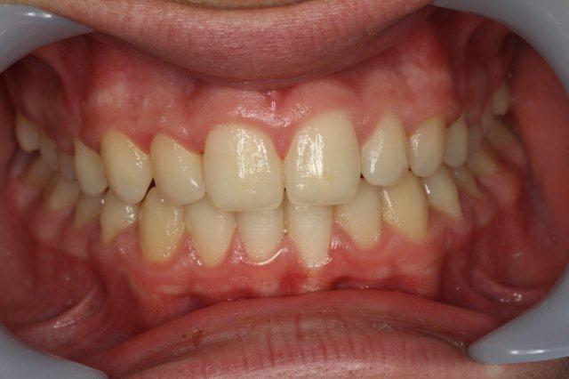 Deep overbite after treatment