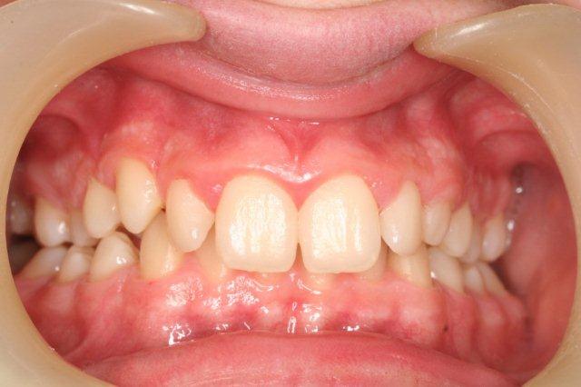 Deep overbite before treatment