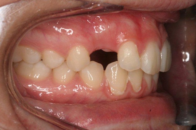 Impacted teeth