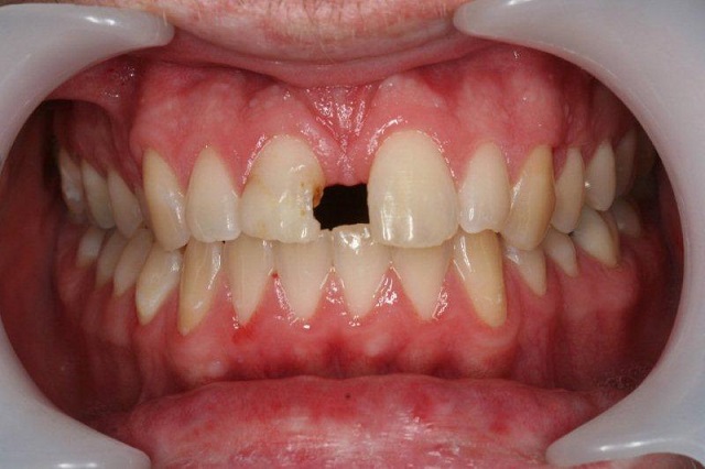 Spaced or missing teeth